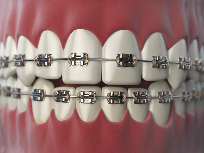 Dental Braces & Orthodontics Clinic in Gangapur Road Nashik | Care 32