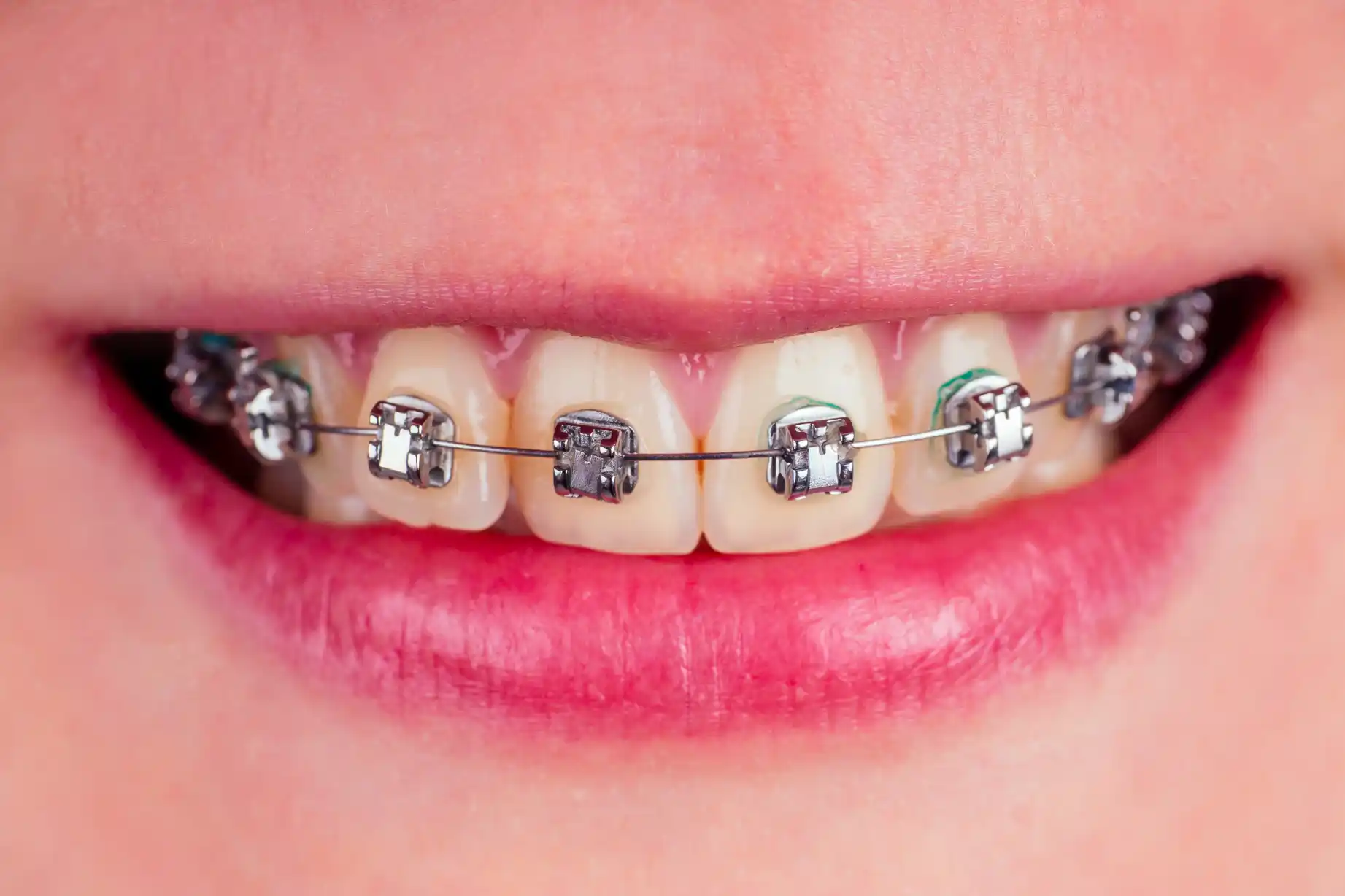 Dental Braces & Orthodontics Clinic in Nashik | Care 32