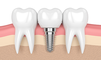 Dental Implant in Canada Corner Nashik | Care32 Dental Clinic