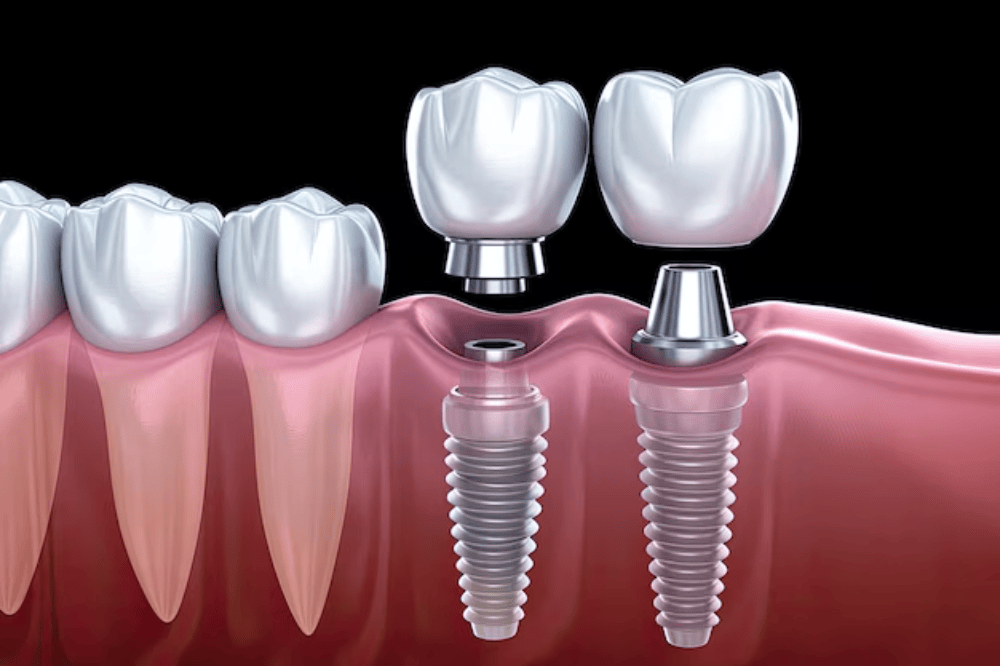 Dental Implant in College Road Nashik | Care32 Dental Clinic