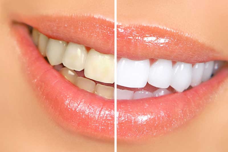 Teeth Whitening Treatment near College Road Nashik | Care 32 Dental