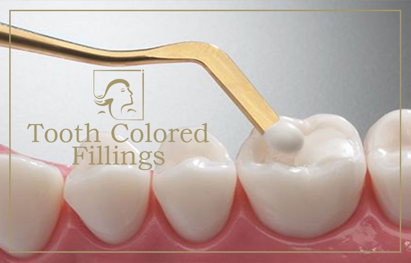 Tooth Color Fillings in College Road Nashik - Dental Clinic