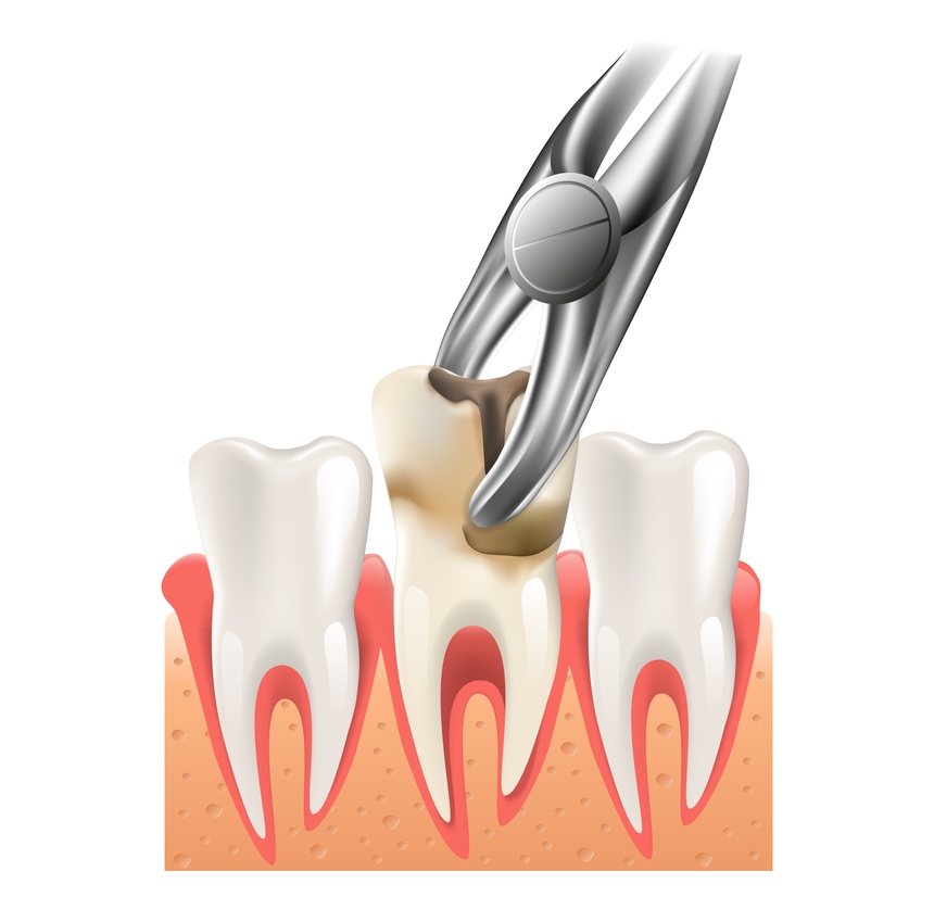 Tooth Extraction Treatment Near College Road Nashik | Care 32