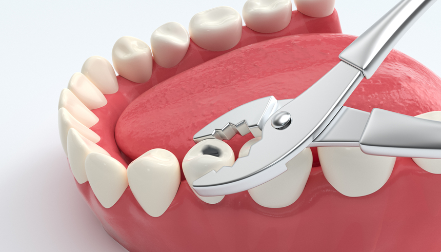 Tooth Extractions in Canada Corner Nashik