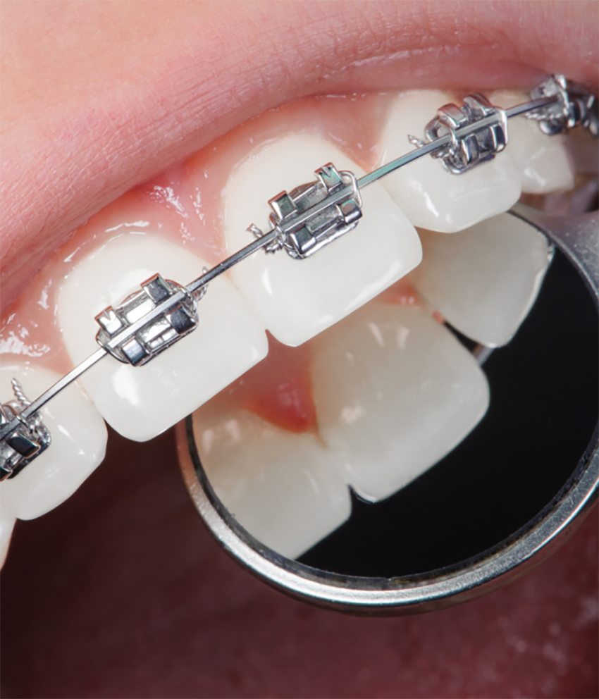 Patient with braces smiling confidently