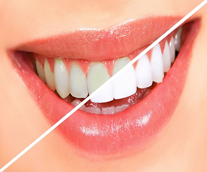 Best Teeth Whitening Clinic in Nashik