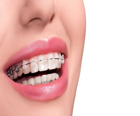 DENTAL BRACES (ORTHODONTICS) by best dentist in nashik at Care32 Dental Implant Center nashik