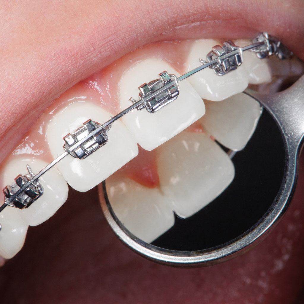 Dental Braces Orthodontics – Care32 Dental & Implant Center Nashik