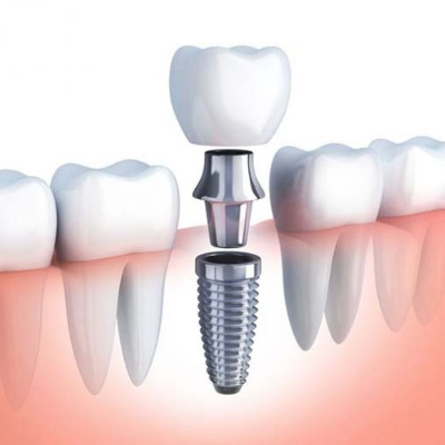 Dental Implants at Care32 Dental Implant Center nashik nampur & manmad