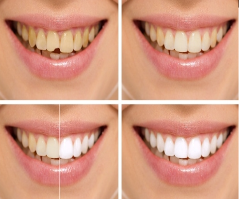 Smile makeover by best dentist in nashik at Care32 Dental Implant Center nashik