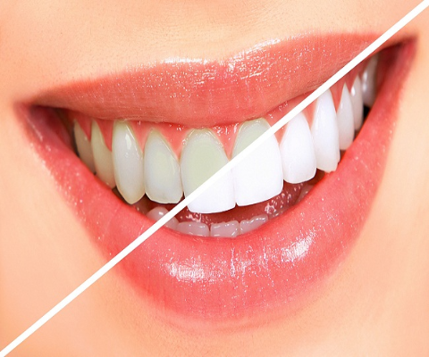 Teeth Whitening by best dentist in nashik at Care32 Dental Implant Center nashik