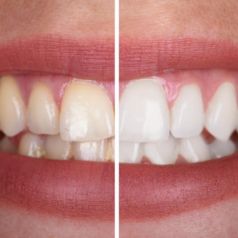Teeth Whitening care 32 dental and implant in nashik