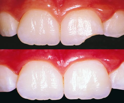 Tooth Color Fillings by best dentist in nashik at Care32 Dental Implant Center nashik