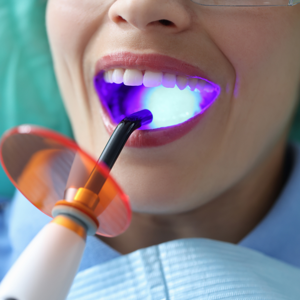 Tooth Color Fillings care 32 dental and implant in nashik