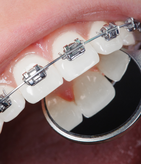 Dental Braces Orthodontics – Care32 Dental & Implant Center Nashik
