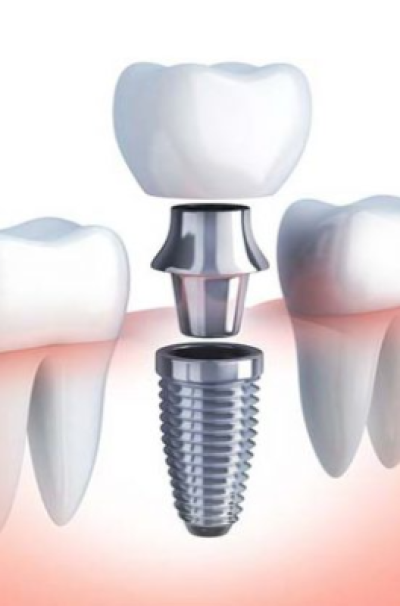 Dental Implants by best dentist in nashik at Care32 Dental Implant Center nashik