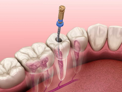 PAINLESS ROOT CANAL TREATMENT by best dentist in nashik at Care32 Dental Implant Center nashik